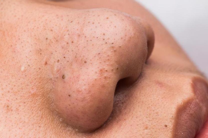 5 Tipps für die Hautpflege in Herbsttüchern mit Mitesser, Akne und Pickeln und verhindert Trockenheit
