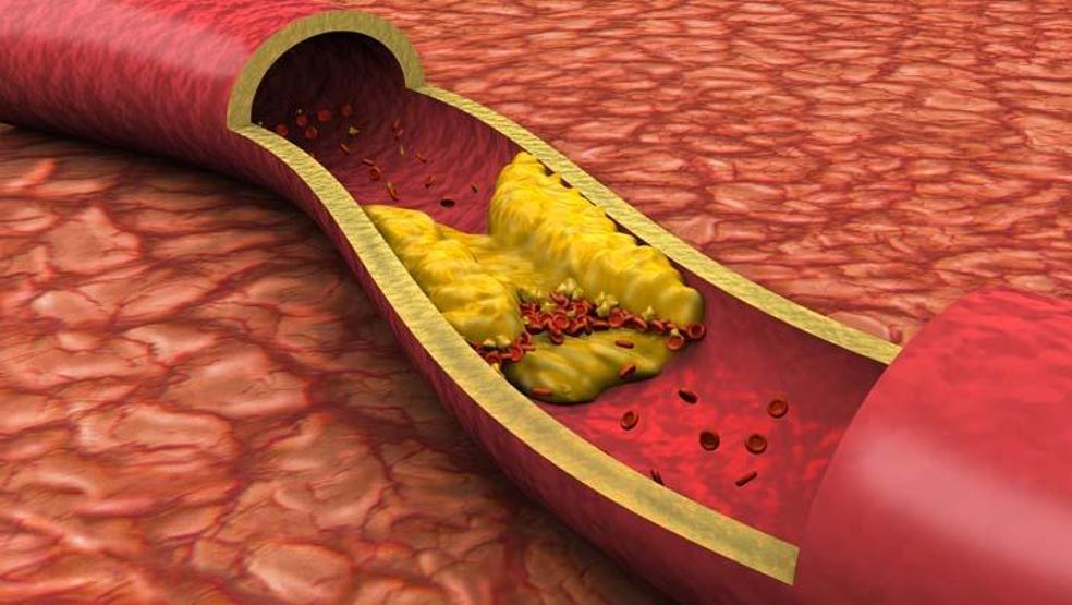 Das schlechte Cholesterinspiegel wirft Ohnmacht, aber ... nicht nur übergewichtig, sondern auch schwache Menschen in Gefahr eines Herzinfarkt